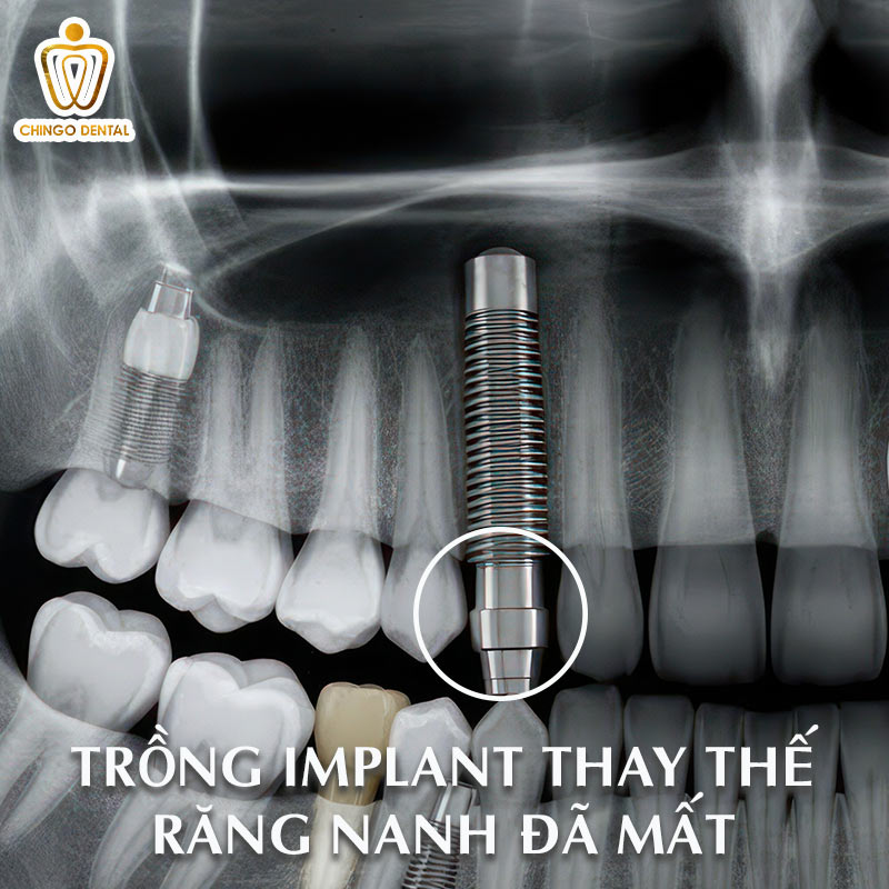 4 Cách Phục Hình Mất Răng Nanh Tốt Nhất Hiện Nay - Giải Pháp Nào Giúp Bạn Có Nụ Cười Chuẩn Tỷ Lệ Vàng? 4 người có 4 răng nanh nhọn