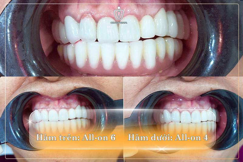 Hạnh Phúc Tìm Lại Sau Những Bữa Cơm "Vắng Vị": Hành Trình Hồi Sinh Nụ Cười Của Cô Trinh 3 nhổ răng hàm bao nhiêu tiền