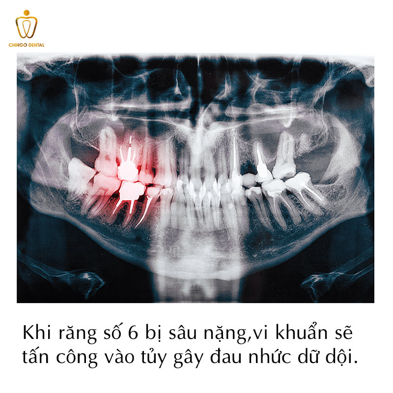 Răng Số 6 Có Thay Không? Sự Thật Về Chiếc 'Răng Cốt Lõi' Và Giải Pháp Phục Hồi Bền Vững - Cẩm Nang Sức Khỏe Cho Bạn 3 nhổ răng số 6 có nguy hiểm không