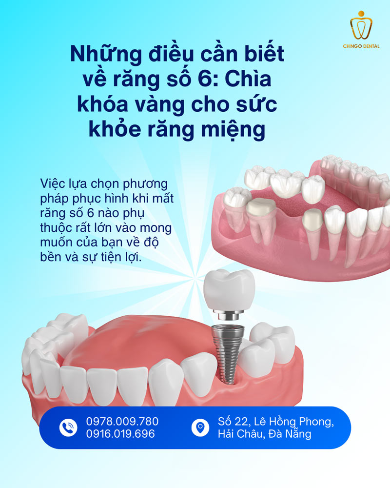 Răng Số 6 Có Thay Không? Sự Thật Về Chiếc 'Răng Cốt Lõi' Và Giải Pháp Phục Hồi Bền Vững - Cẩm Nang Sức Khỏe Cho Bạn 1 nhổ răng số 6