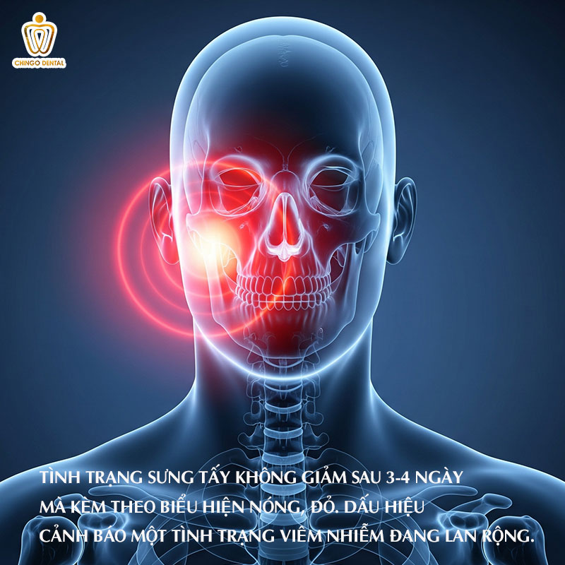 những biến chứng sau khi nhổ răng số 8