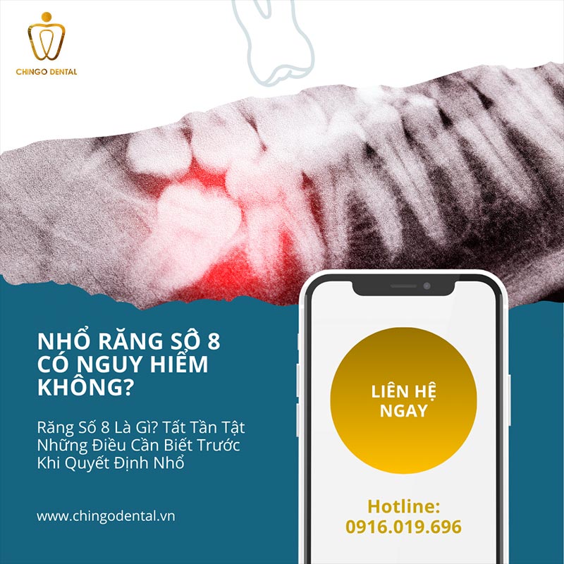 Răng Số 8 Là Răng Gì - Khi Nào Nên Giữ, Khi Nào Cần Nhổ Và Cách Tối Ưu Chi Phí Cho Bạn 6 những biến chứng sau khi nhổ răng số 8