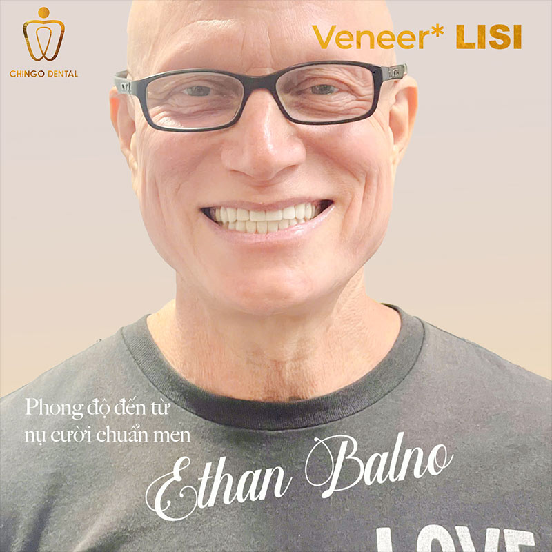 Răng Bị Đen: Cẩm Nang Toàn Diện Về Nguyên Nhân, Điều Trị Và Phòng Ngừa 7 nướu răng bị đen