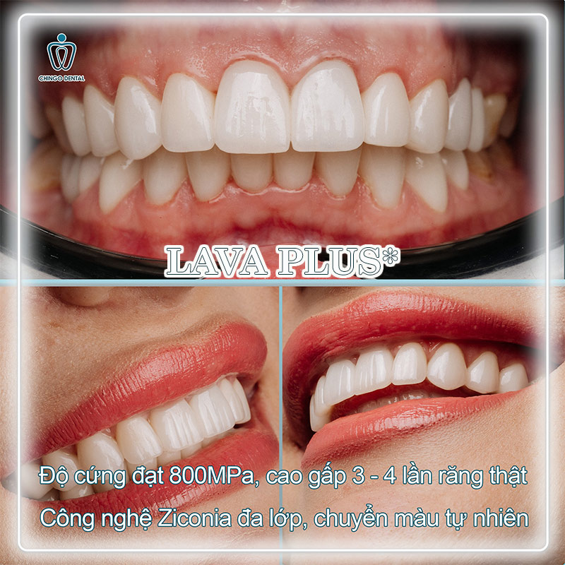 phục hình răng sứ
