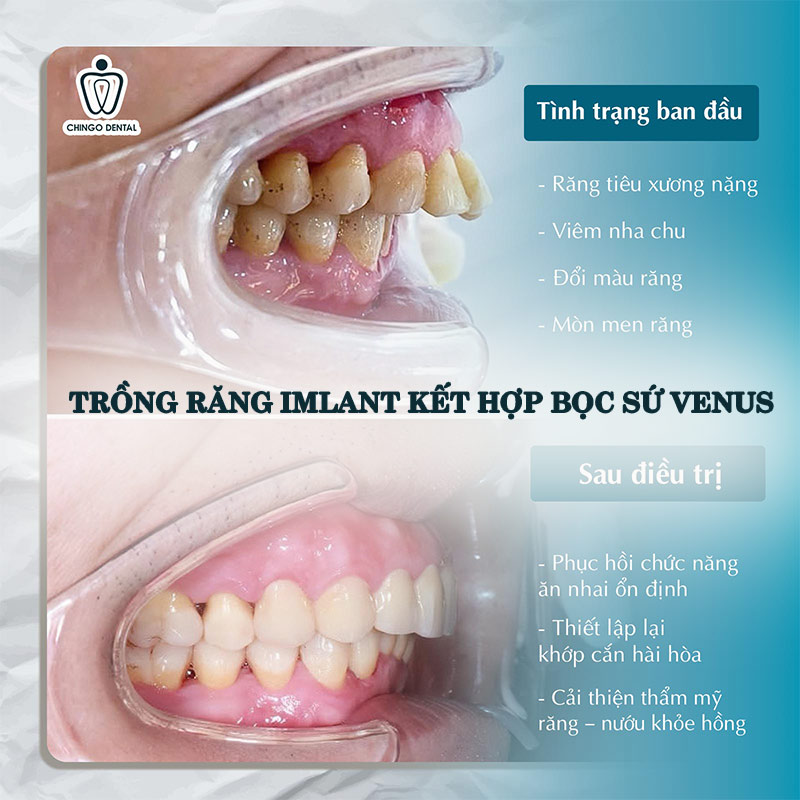 phục hình răng sứ trên implant
