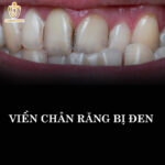 Răng Bị Đen: Cẩm Nang Toàn Diện Về Nguyên Nhân, Điều Trị Và Phòng Ngừa rang-bi-den-o-ke