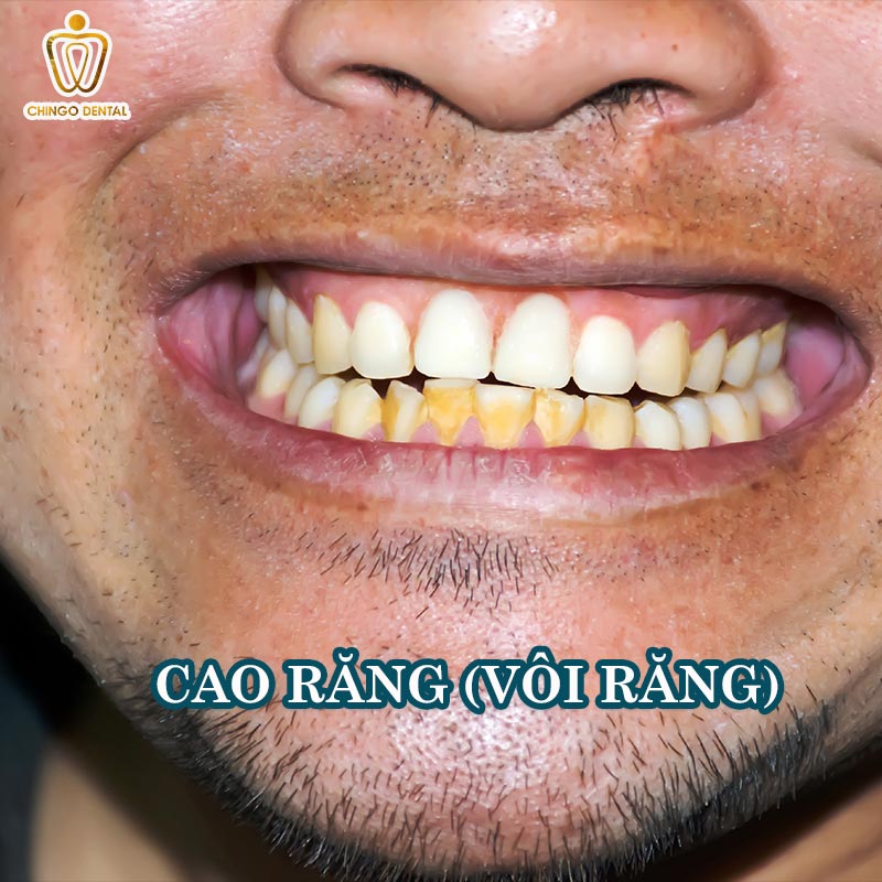 Răng Bị Đen: Cẩm Nang Toàn Diện Về Nguyên Nhân, Điều Trị Và Phòng Ngừa 3 răng bị đen trên bề mặt