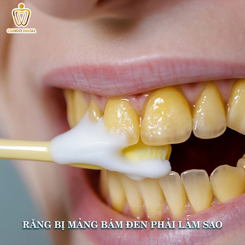 Răng Bị Đen: Cẩm Nang Toàn Diện Về Nguyên Nhân, Điều Trị Và Phòng Ngừa 6 răng bị mảng bám đen phải làm sao