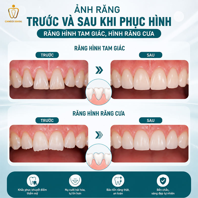 Phục Hình Răng Là Gì: Kỹ Thuật Tái Tạo Nụ Cười Và Chức Năng Ăn Nhai Toàn Diện 4 Ảnh răng trước và sau khi phục hình răng hình tam giác, hình răng cưa