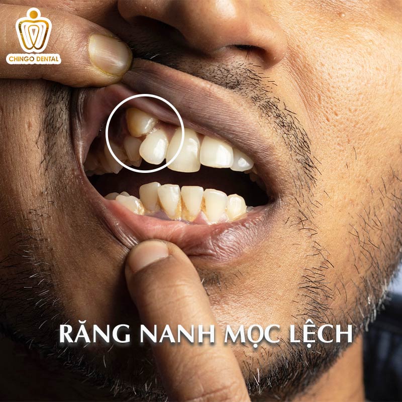 4 Cách Phục Hình Mất Răng Nanh Tốt Nhất Hiện Nay - Giải Pháp Nào Giúp Bạn Có Nụ Cười Chuẩn Tỷ Lệ Vàng? 3 răng nanh hàm trên