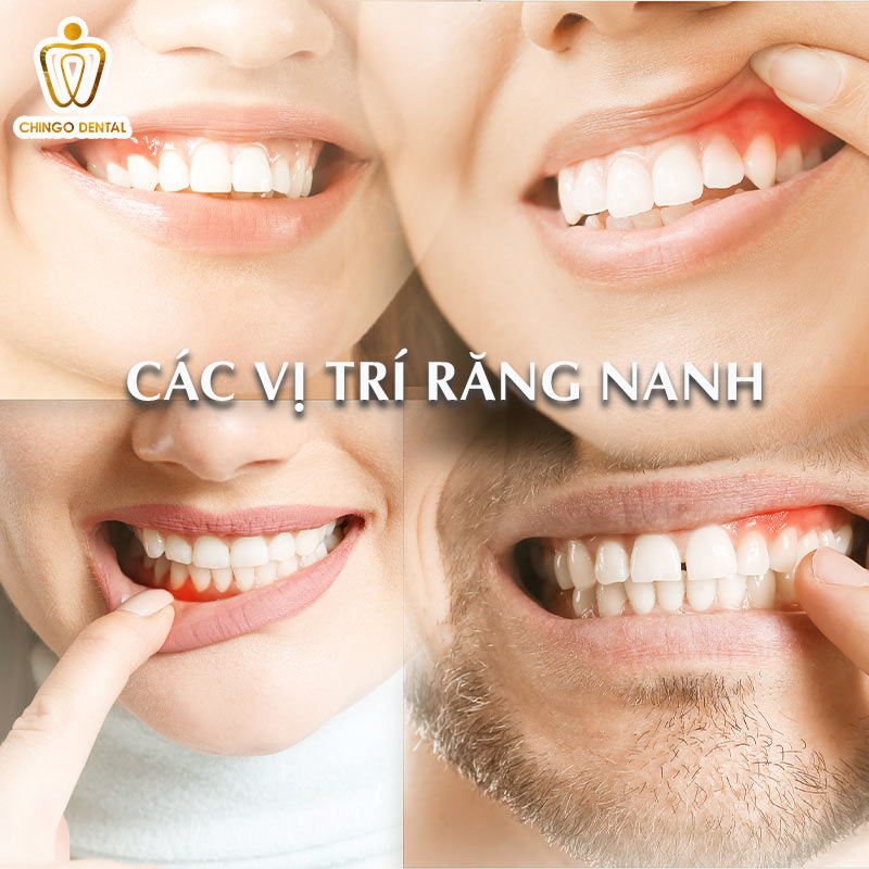 4 Cách Phục Hình Mất Răng Nanh Tốt Nhất Hiện Nay - Giải Pháp Nào Giúp Bạn Có Nụ Cười Chuẩn Tỷ Lệ Vàng? 2 răng nanh nhọn