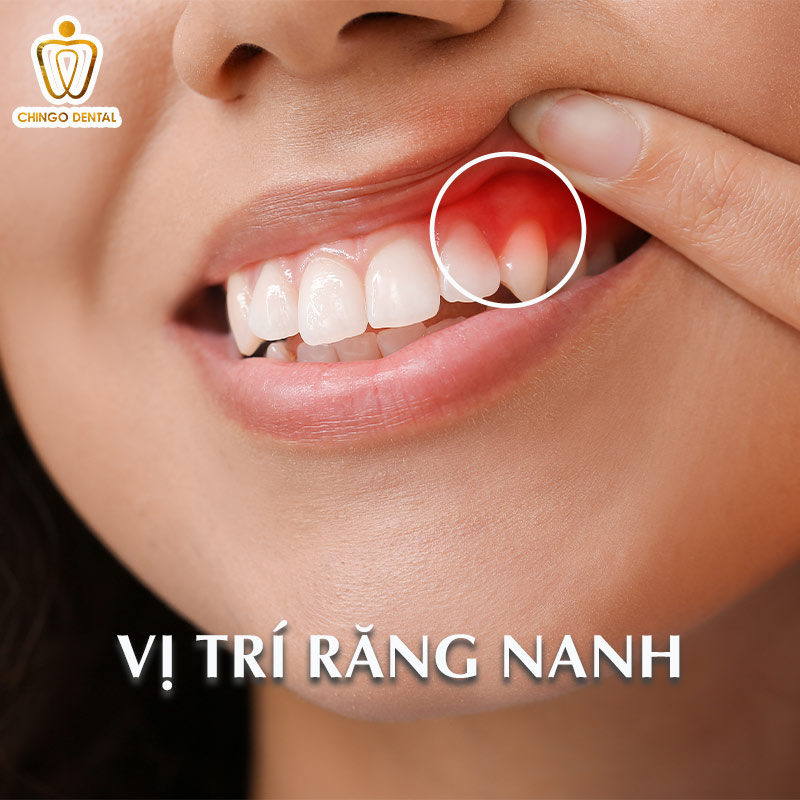 4 Cách Phục Hình Mất Răng Nanh Tốt Nhất Hiện Nay - Giải Pháp Nào Giúp Bạn Có Nụ Cười Chuẩn Tỷ Lệ Vàng? 1 răng nanh ở người