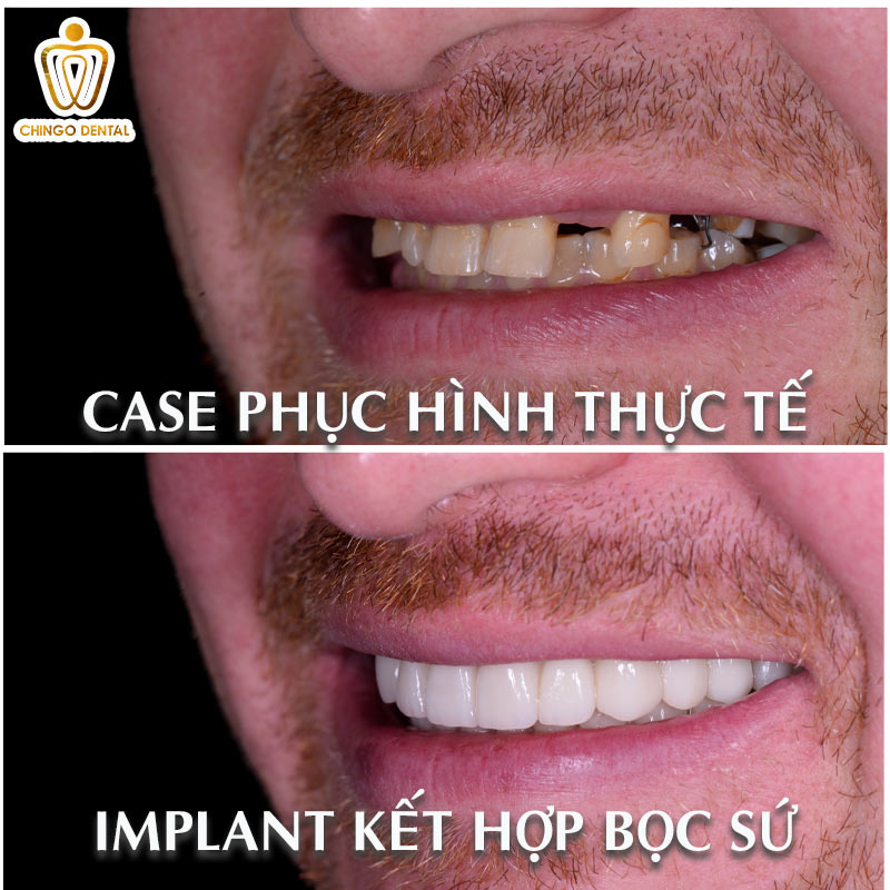 4 Cách Phục Hình Mất Răng Nanh Tốt Nhất Hiện Nay - Giải Pháp Nào Giúp Bạn Có Nụ Cười Chuẩn Tỷ Lệ Vàng? 6 răng nanh rỉ sét