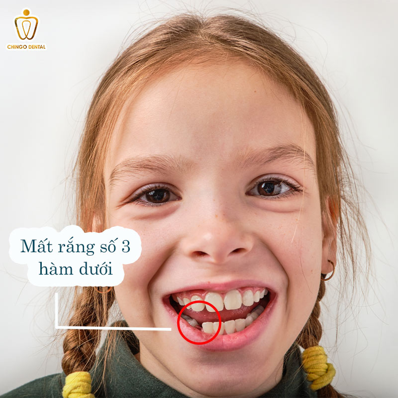 Răng Số 3 Là Răng Nào? Cảnh Báo 6 Hệ Lụy Nguy Hiểm Khi Mất Răng Nanh Mà Bạn Không Nên Xem Thường 2 răng số 3 hàm dưới