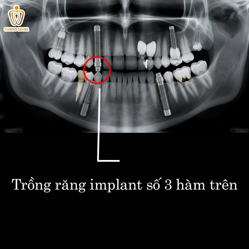 Răng Số 3 Là Răng Nào? Cảnh Báo 6 Hệ Lụy Nguy Hiểm Khi Mất Răng Nanh Mà Bạn Không Nên Xem Thường 5 răng số 3 hàm trên