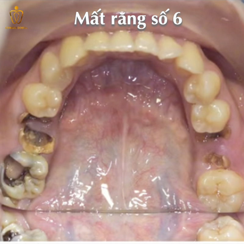 Răng Số 6 Có Thay Không? Sự Thật Về Chiếc 'Răng Cốt Lõi' Và Giải Pháp Phục Hồi Bền Vững - Cẩm Nang Sức Khỏe Cho Bạn 2 răng số 6 bị sâu vỡ