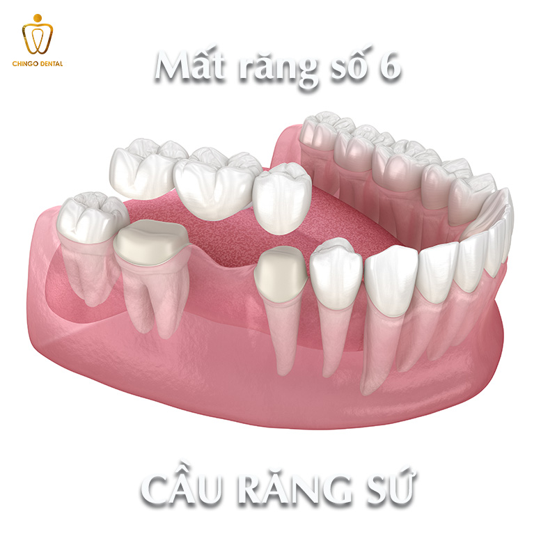 Răng Số 6 Có Thay Không? Sự Thật Về Chiếc 'Răng Cốt Lõi' Và Giải Pháp Phục Hồi Bền Vững - Cẩm Nang Sức Khỏe Cho Bạn 4 răng số 6 có thay không