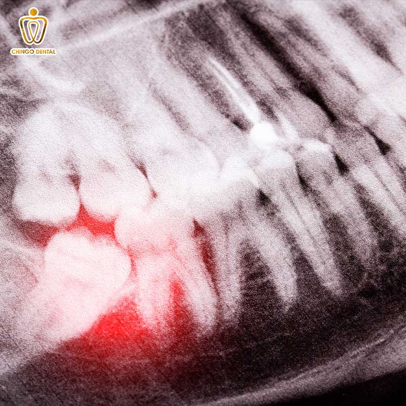 Răng Số 8 Là Răng Gì - Khi Nào Nên Giữ, Khi Nào Cần Nhổ Và Cách Tối Ưu Chi Phí Cho Bạn 3 răng số 8 là răng gì