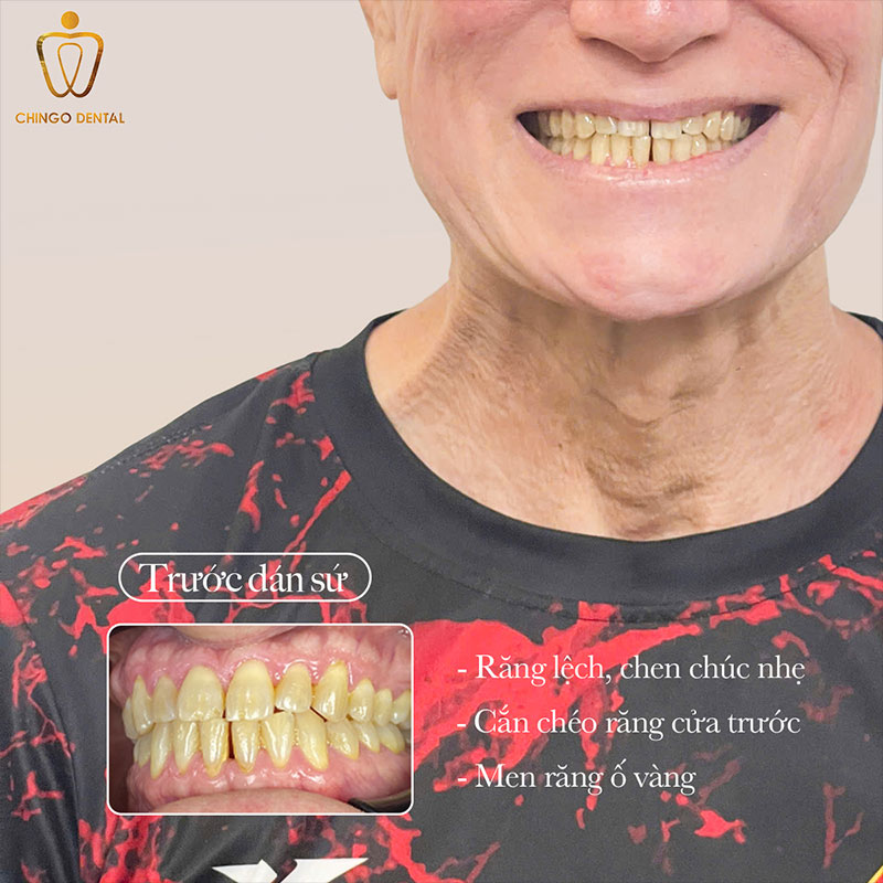 Phong Độ Đến Từ Nụ Cười Chuẩn Men – Câu Chuyện Của Mr. Ethan Balno Tại Chingo Dental 2 răng sứ titan có bị đen không