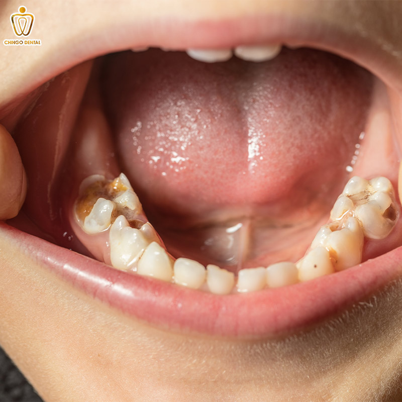 Cẩm Nang Toàn Diện Về Răng Sữa: Những Điều Cha Mẹ Cần Biết Để Bảo Vệ Nụ Cười Đầu Đời Của Bé 4 răng sữa bị sâu