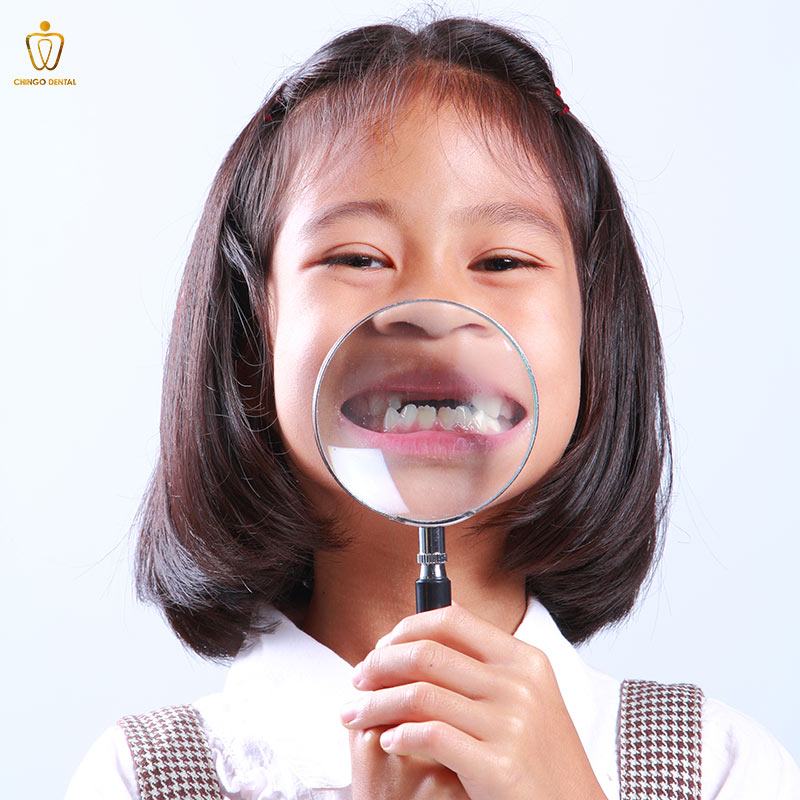 Răng Hàm: Chức Năng, Các Vấn Đề Thường Gặp Và Giải Pháp Điều Trị Tối Ưu 2 sâu răng hàm