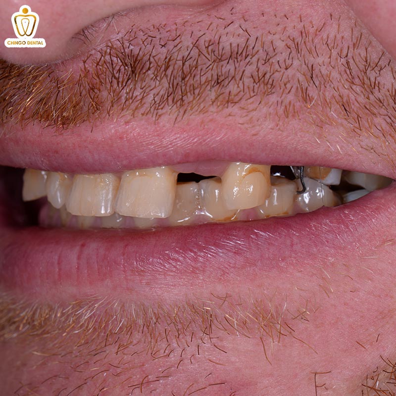 trị sâu răng vĩnh viễn tại nhà