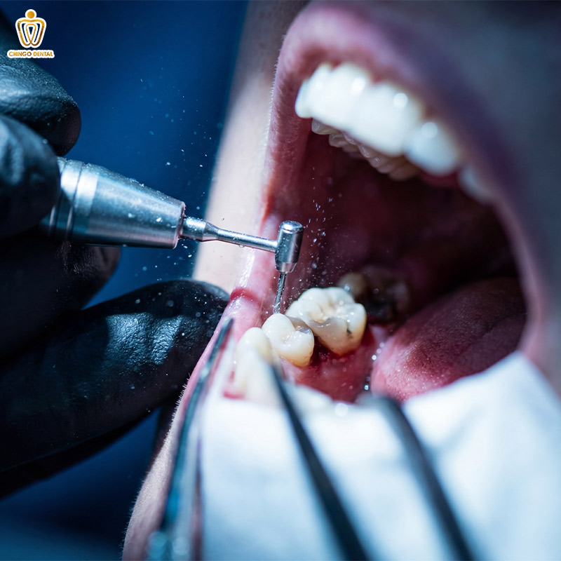 Răng Hàm: Chức Năng, Các Vấn Đề Thường Gặp Và Giải Pháp Điều Trị Tối Ưu 4 trồng răng hàm bị sâu giá bao nhiêu