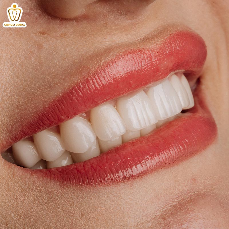 trồng răng sứ vĩnh viễn giá bao nhiêu