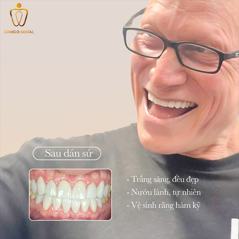 Phong Độ Đến Từ Nụ Cười Chuẩn Men – Câu Chuyện Của Mr. Ethan Balno Tại Chingo Dental 1 viền chân răng bị đen