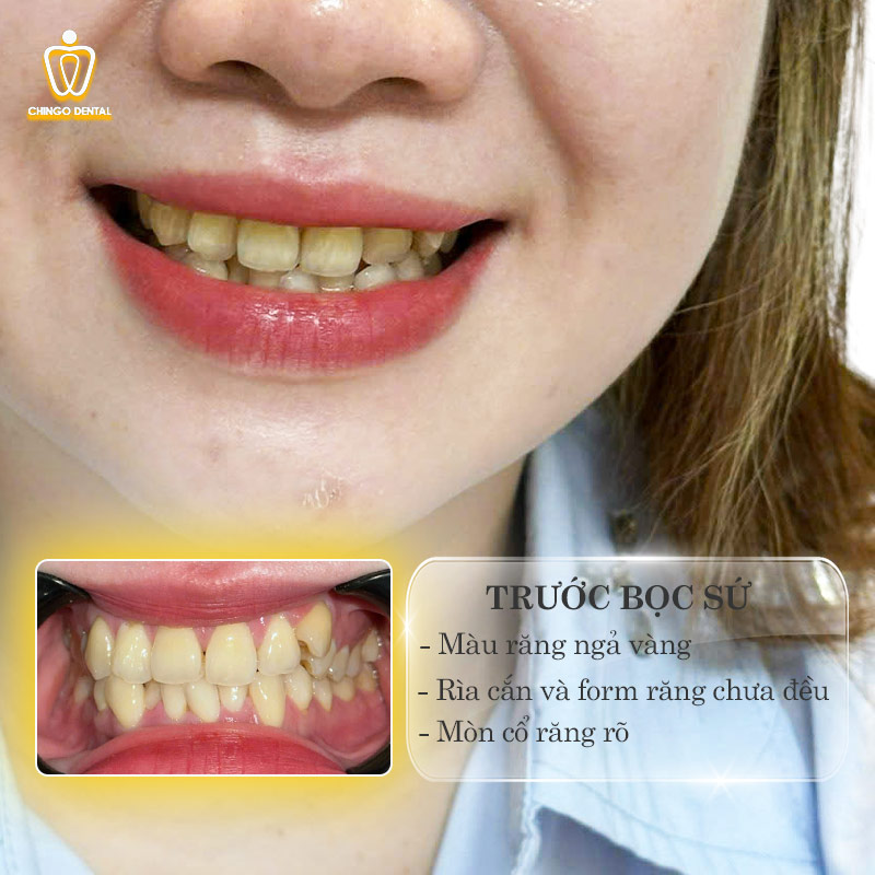 Bọc Răng Sứ Có Giữ Được Răng Khểnh Không? Câu Chuyện Bảo Tồn Nét Duyên Của Chị Kim Tý 1 bọc răng sứ răng khểnh