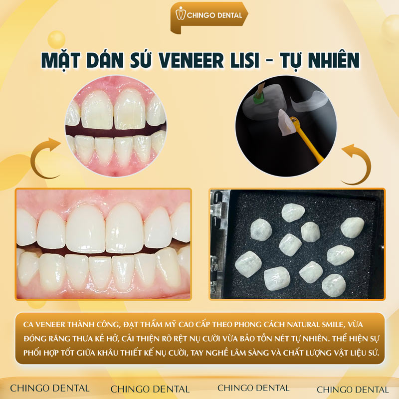 Răng Ố Vàng Xỉn Màu: Nguyên Nhân Và Giải Pháp Lấy Lại Nụ Cười Rạng Rỡ Từ Chuyên Gia 10 cách làm trắng răng bị ố vàng tại nhà