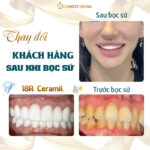 Răng Ố Vàng Xỉn Màu: Nguyên Nhân Và Giải Pháp Lấy Lại Nụ Cười Rạng Rỡ Từ Chuyên Gia cách tẩy trắng răng ố vàng