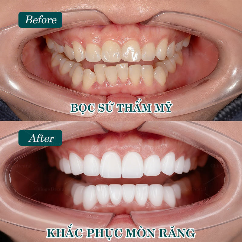 Tổng Quan Bệnh Lý Mòn Răng: Nguyên Nhân, Triệu Chứng Và Cách Điều Trị Hiệu Quả 4 chân răng bị mòn