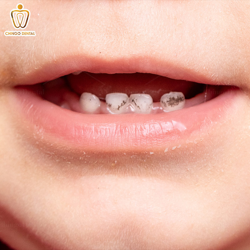 Răng Có Vết Đen Là Gì? Dấu Hiệu Cảnh Báo Bệnh Lý Hay Chỉ Là Mảng Bám? 2 chân răng có vết đen