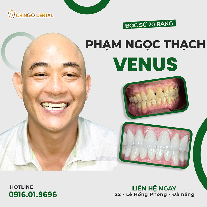 Tạm Biệt Những Cơn Ê Buốt "Thấu Trời": Câu Chuyện Hồi Sinh Nụ Cười Của Anh Thạch 2 mòn cổ răng