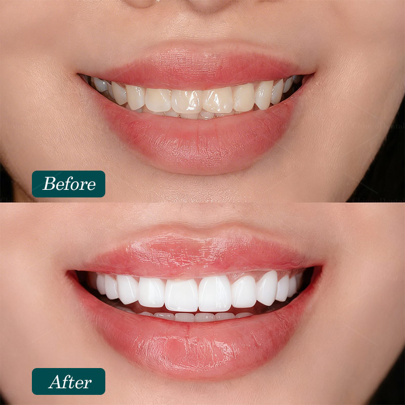 Tổng Quan Bệnh Lý Mòn Răng: Nguyên Nhân, Triệu Chứng Và Cách Điều Trị Hiệu Quả 1 mòn men răng