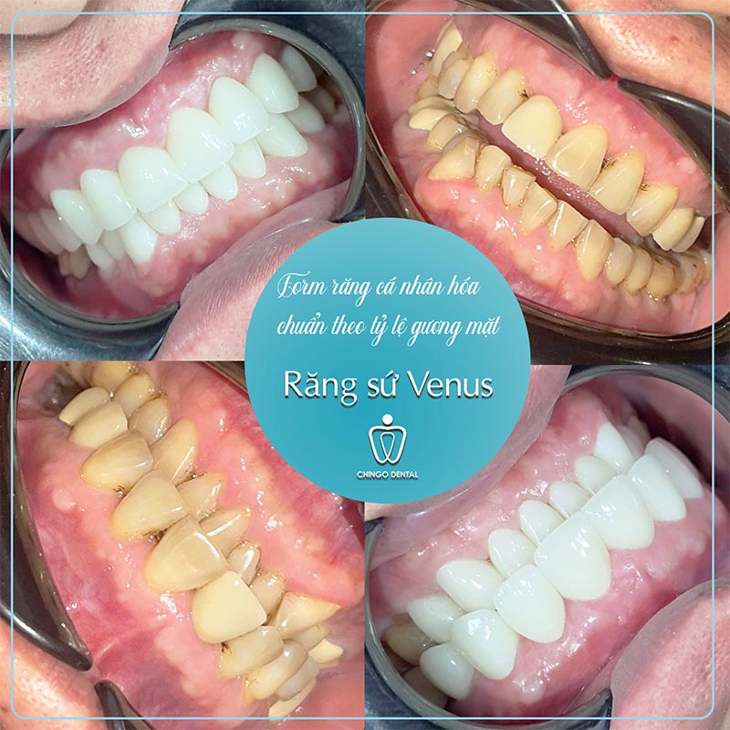 Tạm Biệt Những Cơn Ê Buốt "Thấu Trời": Câu Chuyện Hồi Sinh Nụ Cười Của Anh Thạch 1 mòn răng