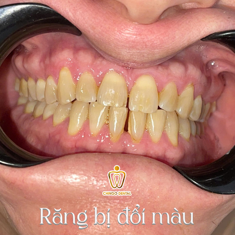 Răng Bị Đổi Màu: Nguyên Nhân Và 3 Giải Pháp Hiệu Quả Khôi Phục Nụ Cười Rạng Rỡ 1 Răng bị đổi màu là gì?