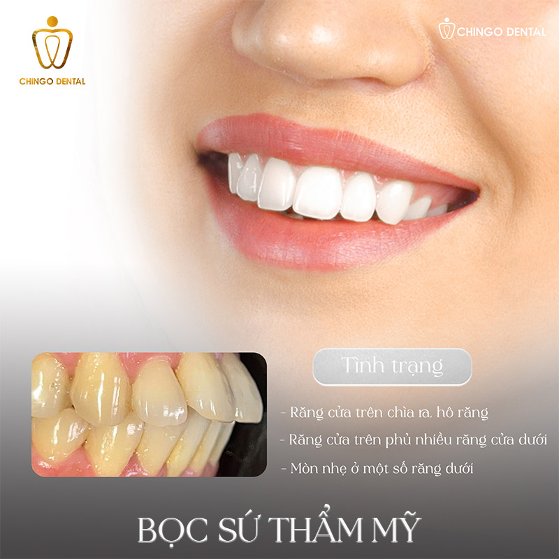 Răng Bị Đổi Màu: Nguyên Nhân Và 3 Giải Pháp Hiệu Quả Khôi Phục Nụ Cười Rạng Rỡ 4 răng bị đổi màu xám đục trong trường hợp