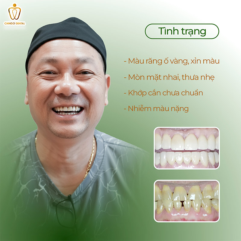 Anh Tuấn Trần Và Quyết Định Trở Về Việt Nam Chỉ Để Được Cười Thật Tự Tin 2 răng bị đổi màu