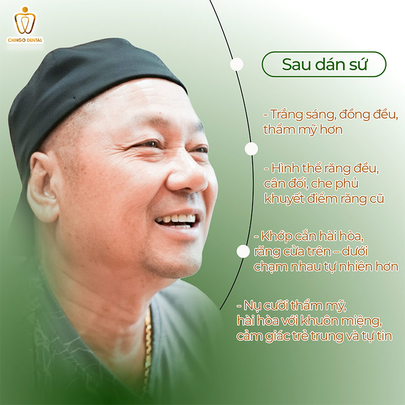 Anh Tuấn Trần Và Quyết Định Trở Về Việt Nam Chỉ Để Được Cười Thật Tự Tin 3 răng bị đổi màu