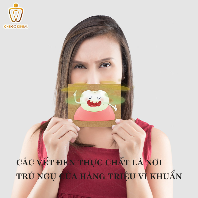 Răng Có Vết Đen Là Gì? Dấu Hiệu Cảnh Báo Bệnh Lý Hay Chỉ Là Mảng Bám? 3 răng có những vết đen