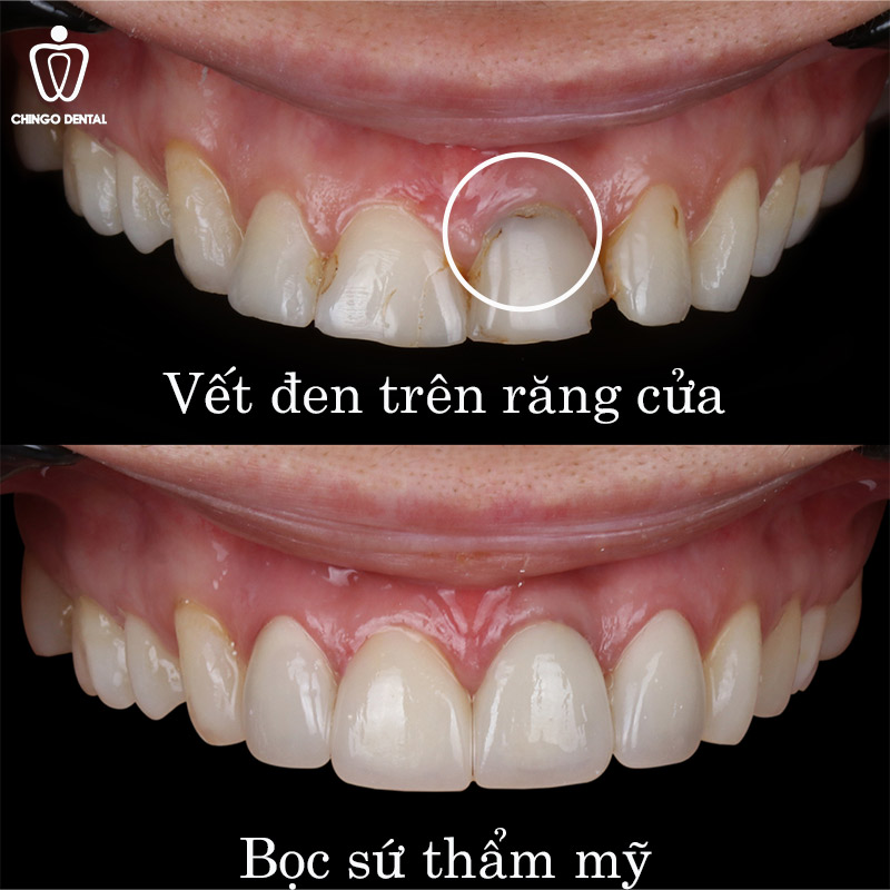 răng có vết đen là bị gì
