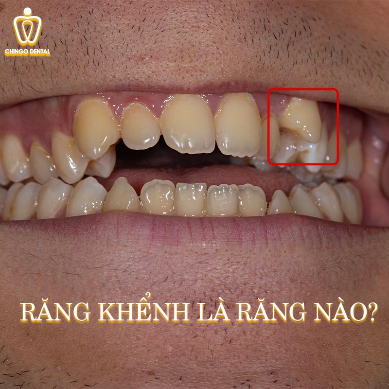 Cẩm Nang Toàn Diện Về Răng Khểnh: Vẻ Đẹp Duyên Dáng Và Những Góc Nhìn Y Khoa Hiện Đại 1 răng khểnh tiếng anh