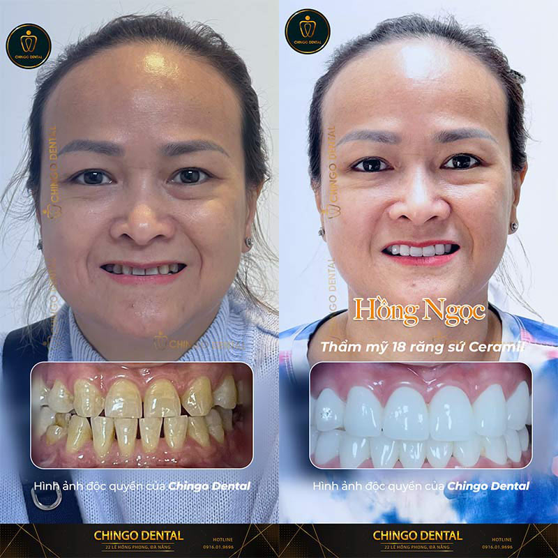 Răng Ố Vàng Xỉn Màu: Nguyên Nhân Và Giải Pháp Lấy Lại Nụ Cười Rạng Rỡ Từ Chuyên Gia 1 răng ố vàng