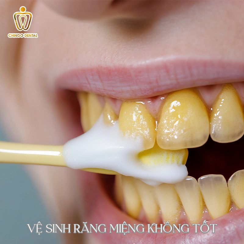 Răng Bị Đổi Màu: Nguyên Nhân Và 3 Giải Pháp Hiệu Quả Khôi Phục Nụ Cười Rạng Rỡ 2 rang su bi doi mau