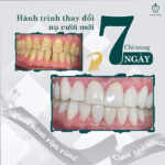 Răng Bị Đổi Màu: Nguyên Nhân Và 3 Giải Pháp Hiệu Quả Khôi Phục Nụ Cười Rạng Rỡ răng sứ bị đổi màu