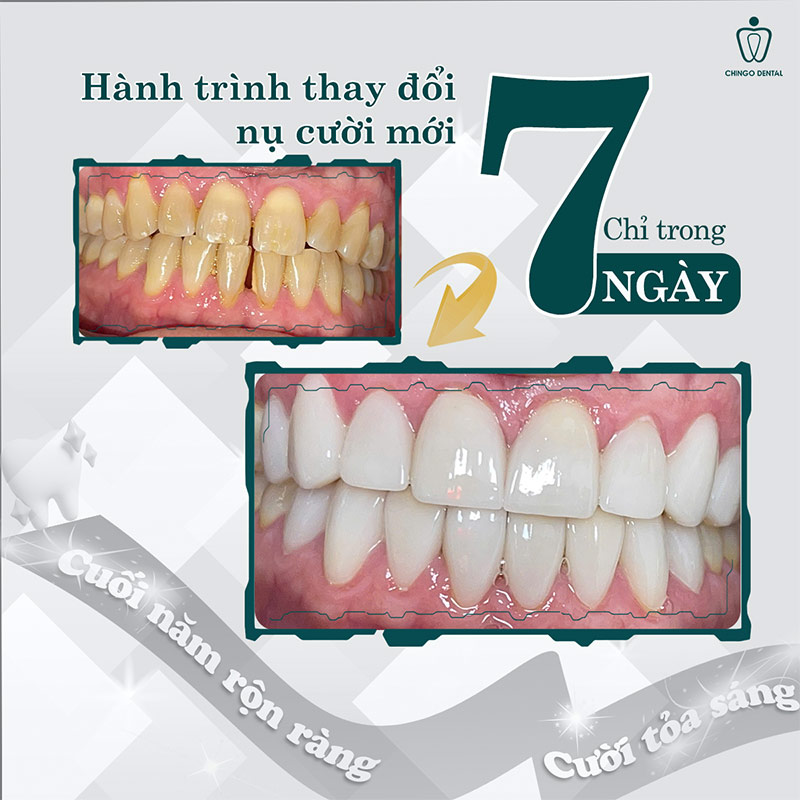 Răng Bị Đổi Màu: Nguyên Nhân Và 3 Giải Pháp Hiệu Quả Khôi Phục Nụ Cười Rạng Rỡ 5 răng sứ bị đổi màu