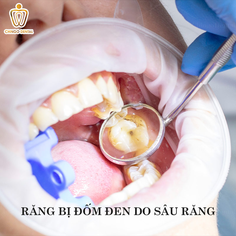 Răng Có Vết Đen Là Gì? Dấu Hiệu Cảnh Báo Bệnh Lý Hay Chỉ Là Mảng Bám? 1 trên răng có vết đen