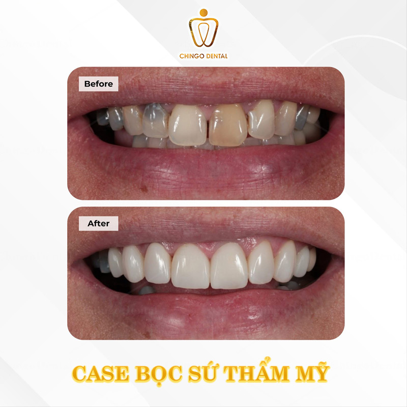 Răng Có Vết Đen Là Gì? Dấu Hiệu Cảnh Báo Bệnh Lý Hay Chỉ Là Mảng Bám? 5 vết nhổ răng khôn có màu đen